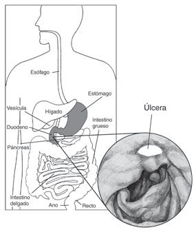 Descripcin: Dibujo del aparato digestivo en la que se sealan el esfago, estmago, hgado, vescula, duodeno, pncreas, intestino delgado, intestino grueso, recto y ano. Un dibujo agrandado del estmago muestra una lcera pptica en la que se seala la lcera.
